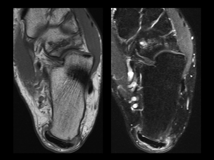 Figure 4 for case navicular-cuboid coalition